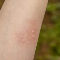 Alergia na ryby objawy - jak je rozpoznać i uniknąć zagrożeń