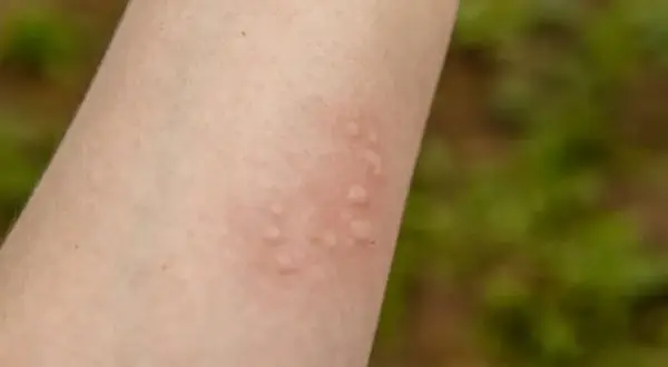 Alergia na ryby objawy - jak je rozpoznać i uniknąć zagrożeń