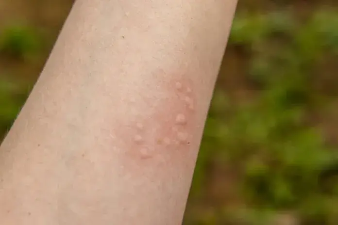 Alergia na ryby objawy - jak je rozpoznać i uniknąć zagrożeń